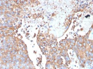 Immunohistochemical analysis of formalin-fixed, paraffin-embedded human urothelial carcinoma using Anti-Uroplakin 1B Antibody [UPK1B/3273]