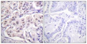 Immunohistochemical analysis of paraffin-embedded human lung carcinoma tissue using Anti-hnRPD Antibody. The right hand panel represents a negative control, where the antibody was pre-incubated with the immunising peptide.