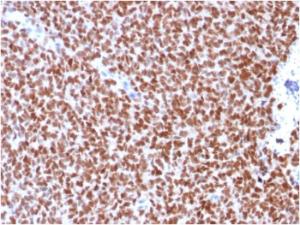 Immunohistochemical analysis of formalin-fixed, paraffin-embedded human Ewing's sarcoma using Anti-NKX2.2 Antibody [rNX2/294]