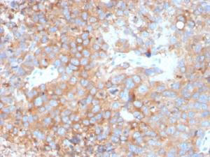 Immunohistochemical analysis of formalin-fixed, paraffin-embedded human urothelial carcinoma using Anti-Uroplakin 1B Antibody [UPK1B/3273]