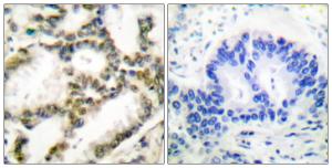 Immunohistochemical analysis of paraffin-embedded human lung carcinoma tissue using Anti-DJ-1 Antibody. The right hand panel represents a negative control, where the Antibody was pre-incubated with the immunising peptide