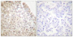 Immunohistochemical analysis of paraffin-embedded human breast carcinoma tissue using Anti-HDAC5 Antibody. The right hand panel represents a negative control, where the antibody was pre-incubated with the immunising peptide