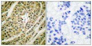 Immunohistochemical analysis of paraffin-embedded human breast cancer using Anti-HDAC5 Antibody 1:100 (4°C overnight). The right hand panel represents a negative control, where the antibody was pre-incubated with the immunising peptide