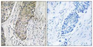 Immunohistochemical analysis of paraffin-embedded human lung carcinoma tissue using Anti-QSK Antibody. The right hand panel represents a negative control, where the antibody was pre-incubated with the immunising peptide