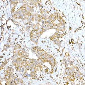 Immunohistochemistry analysis of paraffin-embedded human breast cancer tissue using Anti-IRE1 Antibody (A92812) at a dilution of 1:100 (40x lens) Perform high pressure antigen retrieval with 10 mM citrate buffer pH 60 before commencing with IHC staining protocol