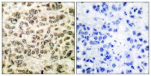 Immunohistochemical analysis of paraffin-embedded human breast carcinoma tissue using Anti-HDAC3 Antibody. The right hand panel represents a negative control, where the antibody was pre-incubated with the immunising peptide.