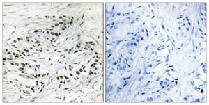 Immunohistochemical analysis of paraffin-embedded human breast carcinoma tissue using Anti-ERF Antibody. The right hand panel represents a negative control, where the antibody was pre-incubated with the immunising peptide