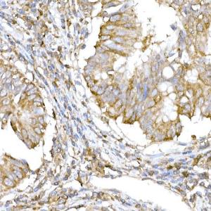 Immunohistochemistry analysis of paraffin-embedded human colon carcinoma tissue using Anti-IRE1 Antibody (A92812) at a dilution of 1:100 (40x lens) Perform high pressure antigen retrieval with 10 mM citrate buffer pH 60 before commencing with IHC staining protocol