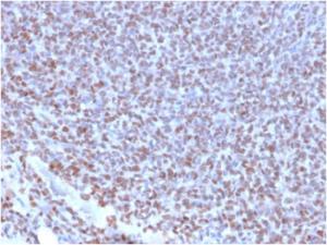 Immunohistochemical analysis of formalin-fixed, paraffin-embedded human Ewing's sarcoma using Anti-NKX2.2 Antibody [NX2/2198R]