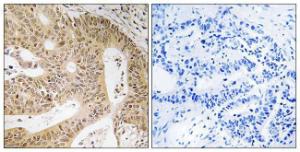 Immunohistochemical analysis of paraffin-embedded human colon carcinoma tissue using Anti-DAP Antibody. The right hand panel represents a negative control, where the antibody was pre-incubated with the immunising peptide