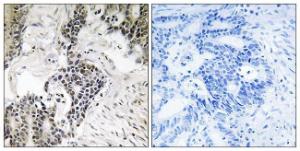 Immunohistochemical analysis of paraffin-embedded human colon carcinoma using Anti-CDC25C (phospho Ser198) Antibody. The right hand panel represents a negative control, where the antibody was pre-incubated with the immunising peptide