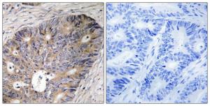 Immunohistochemical analysis of paraffin-embedded human colon carcinoma tissue using Anti-CAD Antibody. The right hand panel represents a negative control, where the antibody was pre-incubated with the immunising peptide.