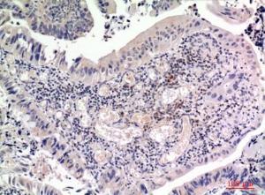 Immunohistochemical analysis of paraffin-embedded human colon cancer using Anti-FGF2 Antibody