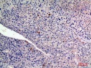 Immunohistochemical analysis of paraffin-embedded human liver cancer using Anti-FGF2 Antibody