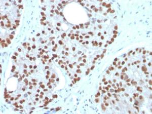 Immunohistochemical analysis of formalin-fixed, paraffin-embedded human prostate carcinoma using Anti-NKX3.1 Antibody [NKX3.1/3350]