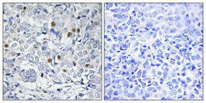 Immunohistochemical analysis of paraffin-embedded human breast cancer using Anti-COT2 Antibody 1:100 (4°C overnight) The right hand panel represents a negative control, where the antibody was pre-incubated with the immunising peptide