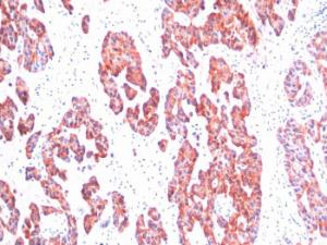 Immunohistochemical analysis of formalin-fixed, paraffin-embedded human breast carcinoma using Anti-Keratin 76 Antibody [SPM116]