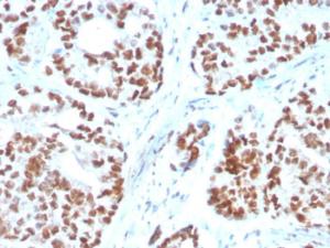 Immunohistochemical analysis of formalin-fixed, paraffin-embedded human prostate carcinoma using Anti-NKX3.1 Antibody [NKX3.1/3350]