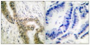 Immunohistochemical analysis of paraffin-embedded human lung carcinoma tissue using Anti-p53 (acetyl Lys386) Antibody. The right hand panel represents a negative control, where the antibody was pre-incubated with the immunising peptide