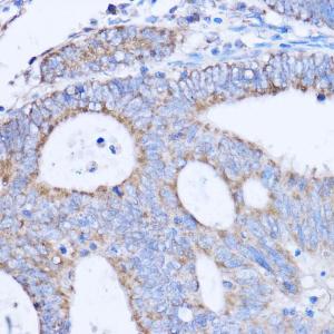 Immunohistochemistry analysis of paraffin-embedded human colon carcinoma tissue using Anti-MT-ND3 Antibody (A92816) at a dilution of 1:100 (40x lens). Perform microwave antigen retrieval with 10 mM PBS buffer pH 7.2 before commencing with IHC staining protocol.