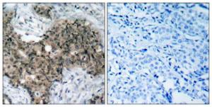 Immunohistochemical analysis of paraffin-embedded human breast carcinoma tissue using Anti-ATM Antibody. The right hand panel represents a negative control, where the antibody was pre-incubated with the immunising peptide.