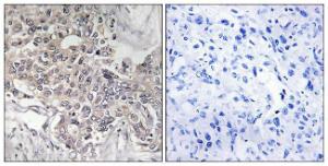 Immunohistochemical analysis of paraffin-embedded human liver carcinoma tissue using Anti-Cytochrome P450 4Z1 Antibody. The right hand panel represents a negative control, where the antibody was pre-incubated with the immunising peptide