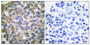 Immunohistochemical analysis of paraffin-embedded human breast carcinoma tissue using Anti-GRP75 Antibody. The right hand panel represents a negative control, where the antibody was pre-incubated with the immunising peptide.