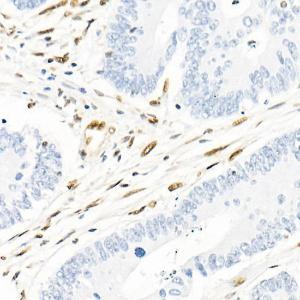 Immunohistochemistry analysis of paraffin-embedded human colon carcinoma tissue using Anti-QKI Antibody [ARC2500] (A8374) at a dilution of 1:1,000 (40x lens). Perform microwave antigen retrieval with 10 mM citrate buffer pH 6.0 before commencing with IHC staining protocol.