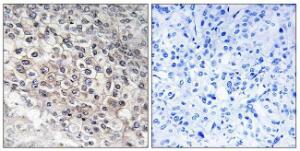 Immunohistochemical analysis of paraffin-embedded human liver carcinoma tissue using Anti-Cytochrome P450 2W1 Antibody. The right hand panel represents a negative control, where the antibody was pre-incubated with the immunising peptide.