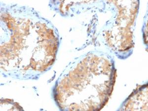 Immunohistochemical analysis of formalin-fixed, paraffin-embedded human testicular carcinoma using Anti-Vinculin Antibody [VCL/2573]