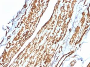 Immunohistochemical analysis of formalin-fixed, paraffin-embedded human testicular carcinoma using Anti-Vinculin Antibody [VCL/2575]