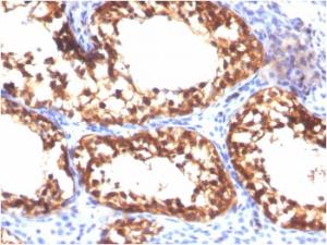 Immunohistochemical analysis of formalin-fixed, paraffin-embedded human testicular carcinoma using Anti-Vinculin Antibody [VCL/3617]