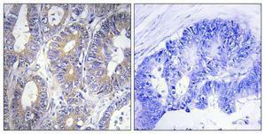 Immunohistochemical analysis of paraffin-embedded human colon cancer using Anti-BCLW Antibody 1:100 (4 °C overnight). The right hand panel represents a negative control, where the antibody was pre-incubated with the immunising peptide