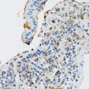 Immunohistochemistry analysis of paraffin-embedded human gastric cancer using Anti-c-Kit Antibody (A8390) at a dilution of 1:100 (40x lens). Perform high pressure antigen retrieval with 10 mM citrate buffer pH 6.0 before commencing with IHC staining protocol.