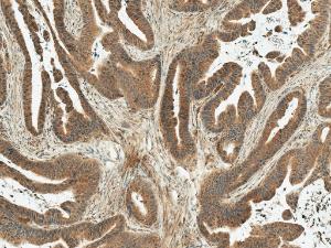 Immunohistochemistry analysis of human stomach cancer, fixed in formalin and paraffin-embedded