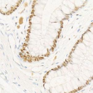 Immunohistochemistry analysis of paraffin-embedded human colon tissue using Anti-Chk2 Antibody [ARC57076] (A306128) at a dilution of 1:300 (40x lens). Perform high pressure antigen retrieval with 10 mM citrate buffer pH 6.0 before commencing with IHC staining protocol.