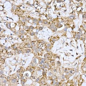 Immunohistochemistry analysis of paraffin-embedded human breast cancer tissue using Anti-ND6 Antibody (A92852) at a dilution of 1:100 (40x lens) Perform high pressure antigen retrieval with 10 mM citrate buffer pH 60 before commencing with IHC staining protocol