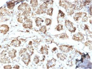 Immunohistochemical analysis of formalin-fixed, paraffin-embedded human breast carcinoma using Anti-NME2 Antibody [CPTC-NME2-2]