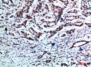 Immunohistochemical analysis of paraffin-embedded human breast cancer using Anti-VIM Antibody