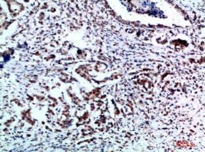 Immunohistochemical analysis of paraffin-embedded human breast cancer using Anti-VIM Antibody