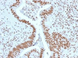 Immunohistochemical analysis of formalin-fixed, paraffin-embedded human colon carcinoma using Anti-Nucleophosmin Antibody [NPM1/1902]