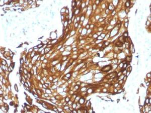 Immunohistochemical analysis of formalin-fixed, paraffin-embedded human lung carcinoma using Anti-Keratin 77 Antibody [KRTL/1577R]