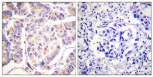 Immunohistochemical analysis of paraffin-embedded human breast carcinoma tissue using Anti-SYK Antibody. The right hand panel represents a negative control, where the antibody was pre-incubated with the immunising peptide.