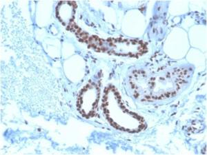 Immunohistochemical analysis of formalin-fixed, paraffin-embedded human basal cell carcinoma using Anti-Nucleophos min Antibody [NPM1/3285]