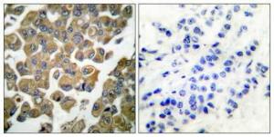 Immunohistochemical analysis of paraffin-embedded human breast cancer using Anti-SYK Antibody 1:100 (4°C overnight). The right hand panel represents a negative control, where the antibody was pre-incubated with the immunising peptide.