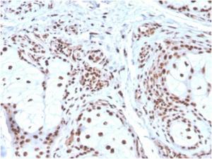 Immunohistochemical analysis of formalin-fixed, paraffin-embedded human basal cell carcinoma using Anti-Nucleophosmin Antibody [NPM1/3286]