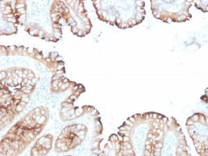 Immunohistochemical analysis of formalin-fixed, paraffin-embedded human colon carcinoma using Anti-Villin Antibody [VIL1/1314 + VIL1/2376]