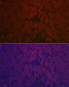 Immunofluorescence analysis of human liver cancer using Anti-NNMT Antibody (A92881) at a dilution of 1:50 (40x lens). DAPI was used to stain the cell nuclei (blue).