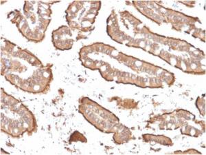 Immunohistochemical analysis of formalin-fixed, paraffin-embedded human small intestinal carcinoma using Anti-Villin Antibody [rVIL1/1325]