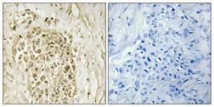 Immunohistochemical analysis of paraffin-embedded human breast cancer using Anti-CREM Antibody 1:100 (4°C overnight). The right hand panel represents a negative control, where the antibody was pre-incubated with the immunising peptide